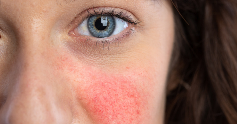Couperose: cos’è, cause e rimedi per il benessere della pelle