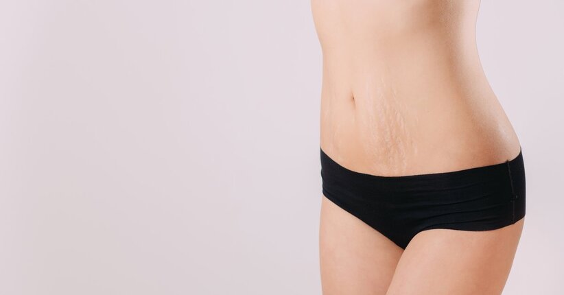Smagliature: prevenirle, trattarle ed eliminarle è possibile?