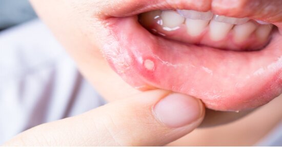 Afte della bocca: 5 rimedi naturali per eliminarle
