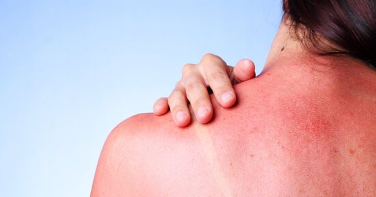 Allergia al sole: i rimedi naturali