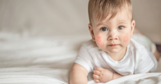 Dermatite atopica nei bambini: sintomi, test e rimedi naturali