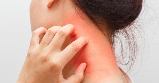 Dermatite da contatto ed eczema: i rimedi naturali