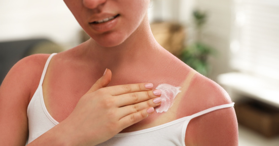 Eritema solare: i rimedi naturali per proteggere la pelle dal sole