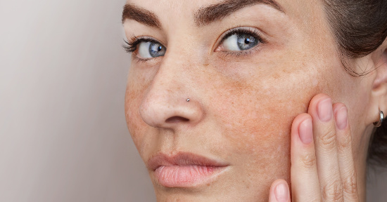 Macchie della pelle: i rimedi naturali