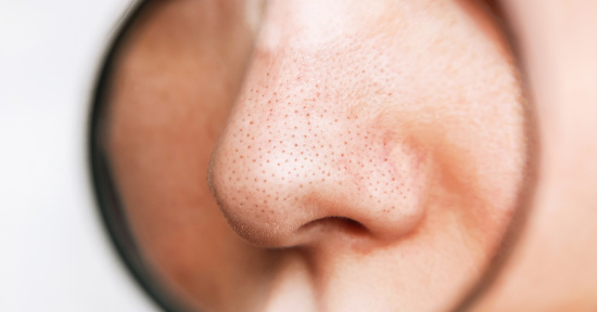 Punti neri: cause e come toglierli con rimedi naturali