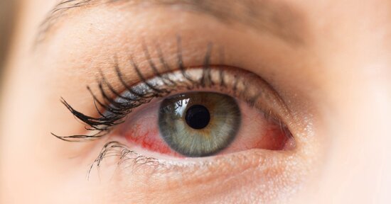 Secchezza oculare: 5 rimedi naturali