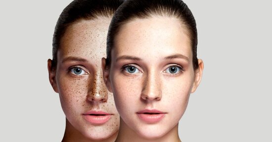 Macchie della pelle: come eliminare e prevenire le discromie cutanee