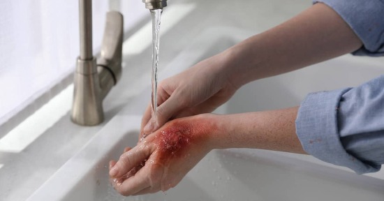 Ustioni: l'omeopatia ci viene in aiuto