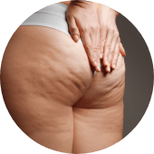 cellulite
