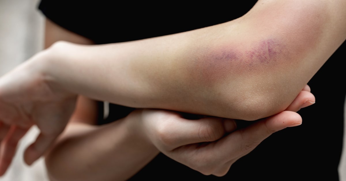 L'Arnica è uno dei rimedi naturali più usati per alleviare contusioni, lividi ed ematomi