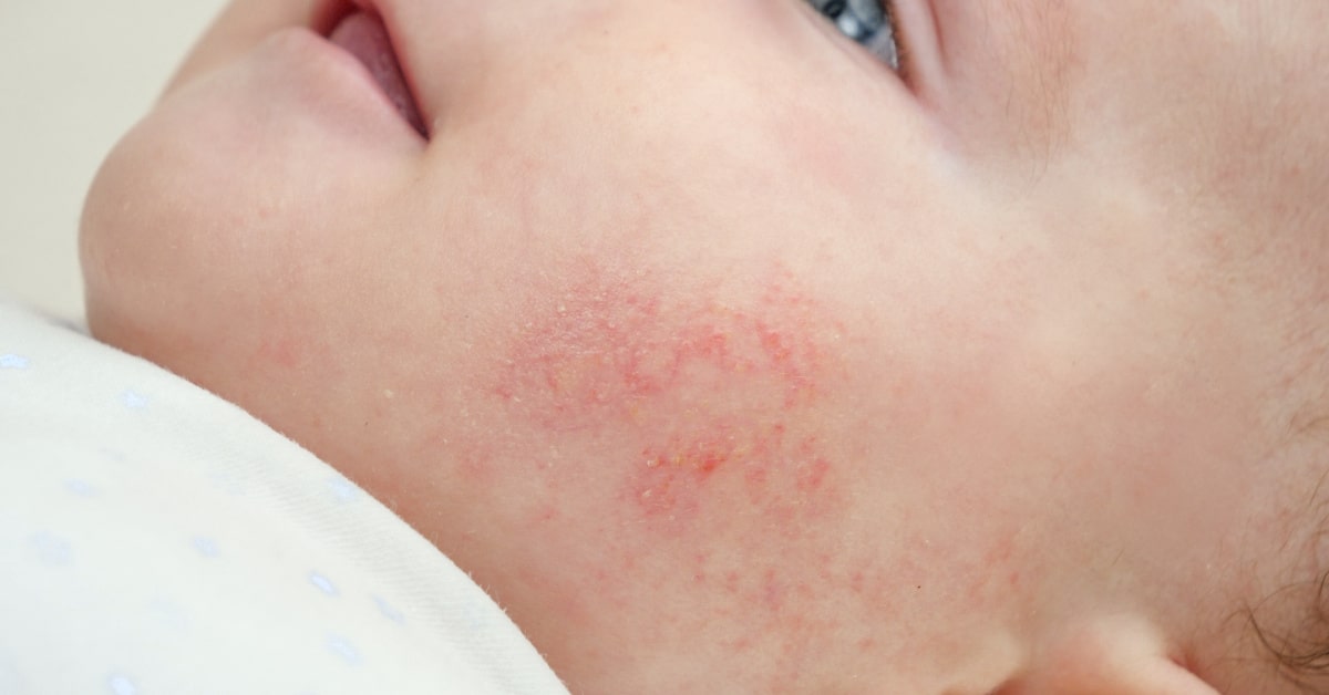 Primo piano del viso di un neonato con dermatite su una guancia