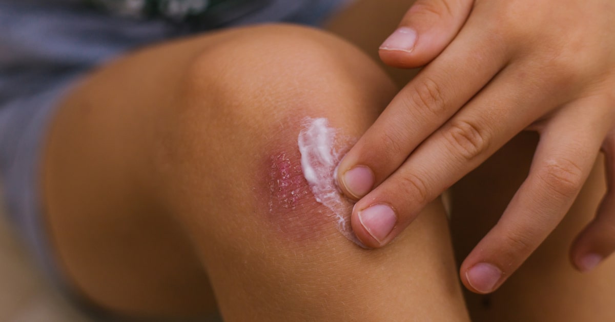 Ginocchio di bambino con livido su cui viene spalmata una crema lenitva