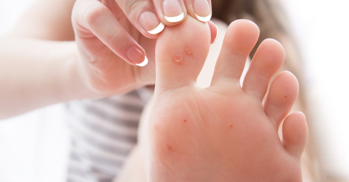 Donna che mostra la pianta del piedi con problemi di verruche