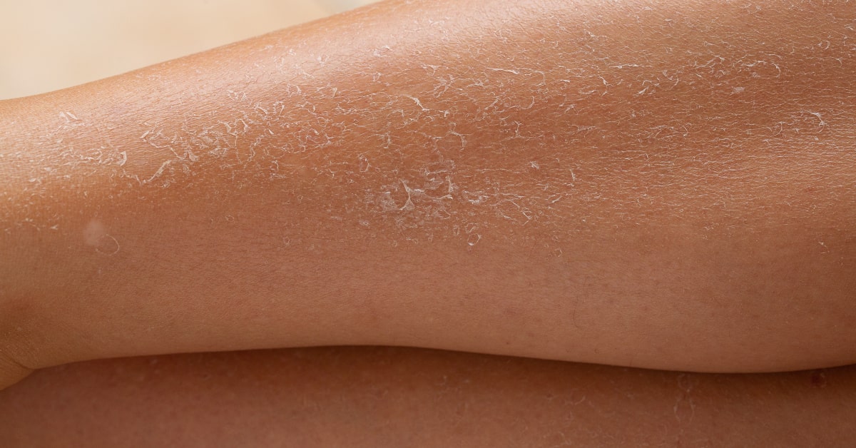 Gambe di donna con pelle secca