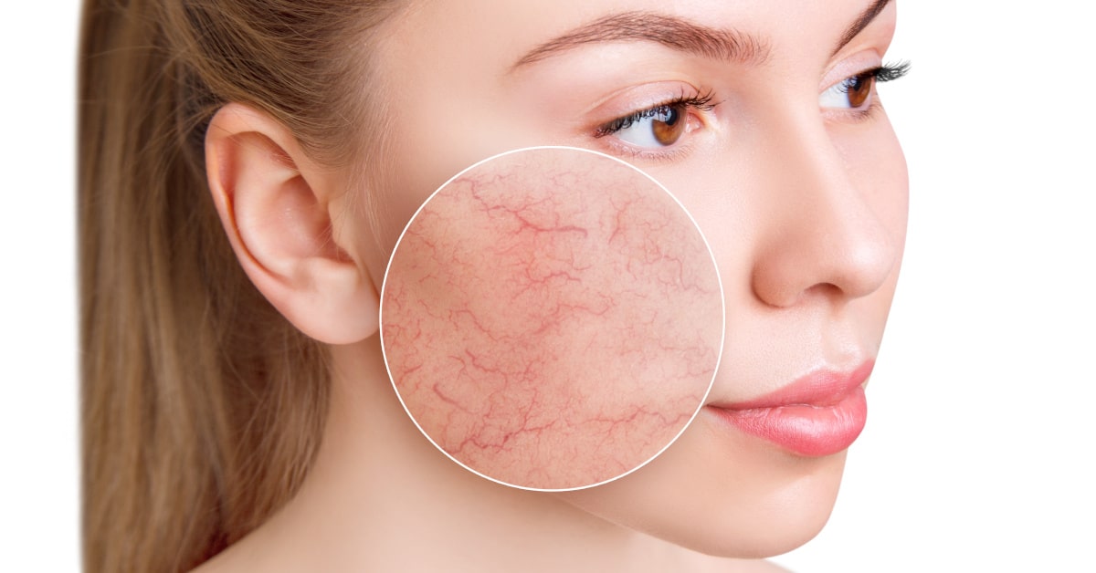 Viso di donna in primo piano, con ingrandimento della pelle con problemi di circolazione e couperose