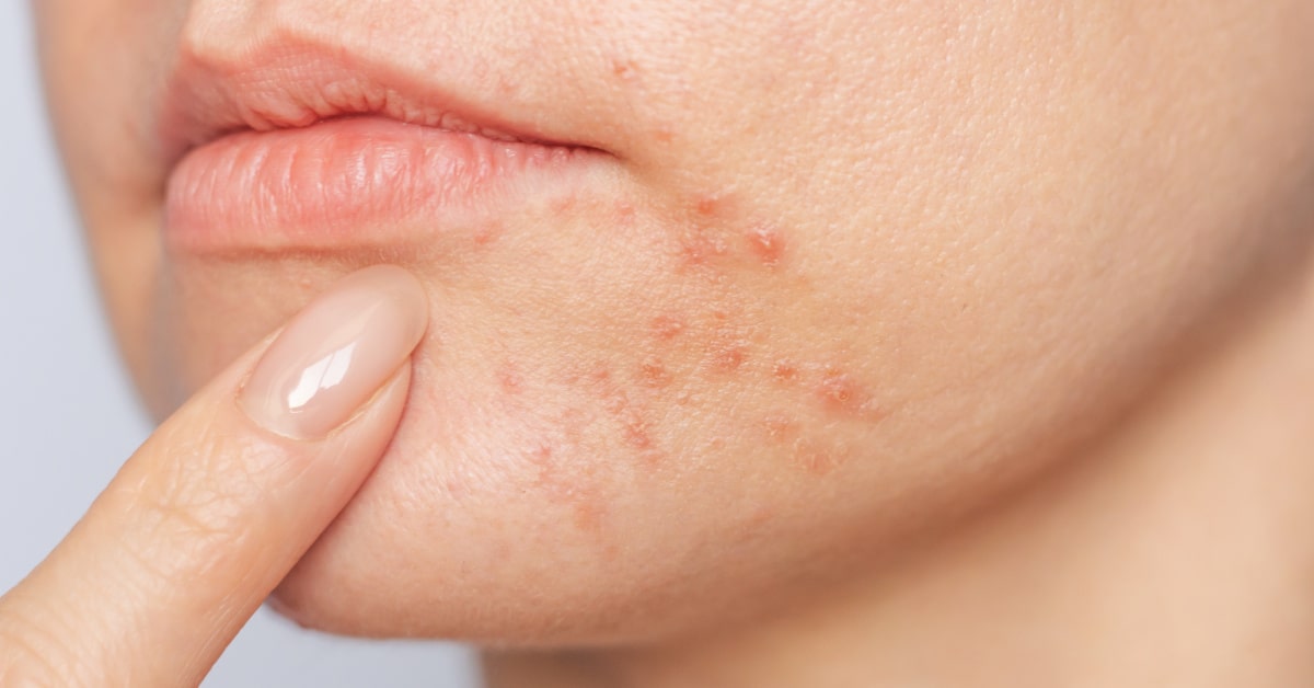 Primo piano del viso di una donna con dermatite