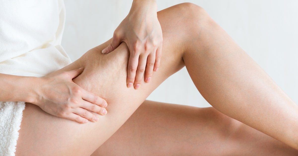 Donna che stringe la pelle della coscia per evidenziare la cellulite