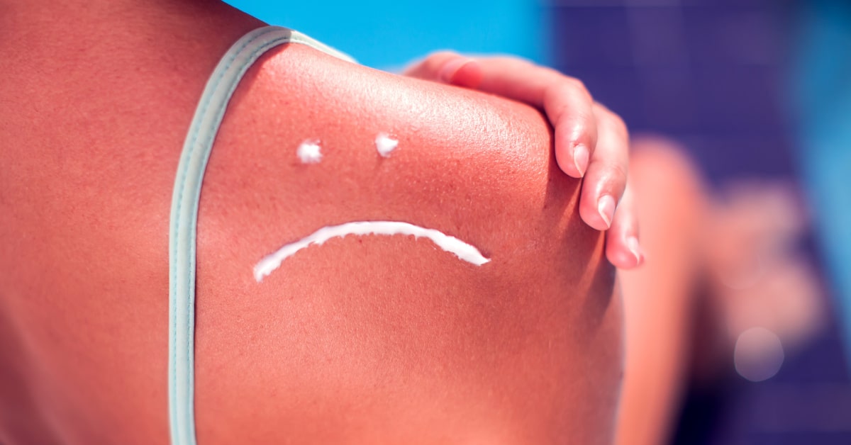 Schiena di donna arrossata per troppo sole