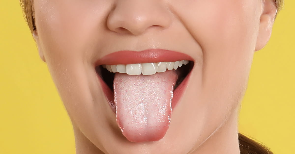 Lingua con patina biancastra, sintomo della candida