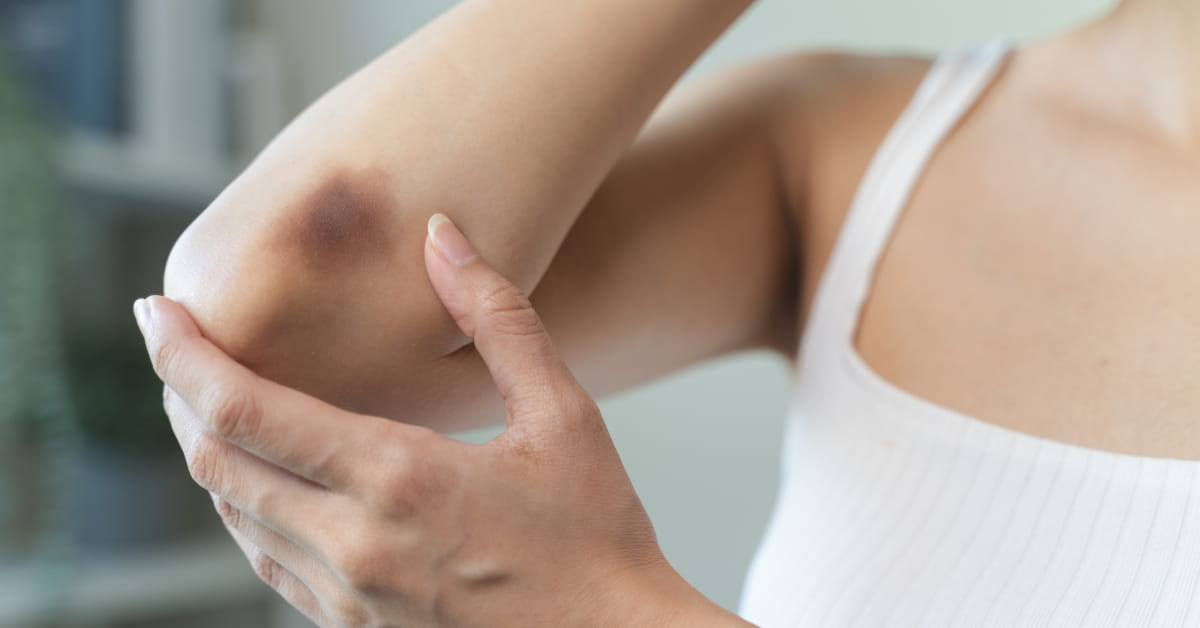 Arnica: quando usarla
