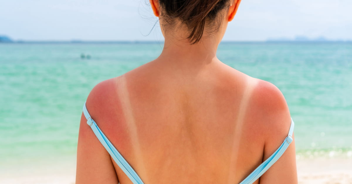 Pelle arrossata dal sole: rimedi naturali di emergenza